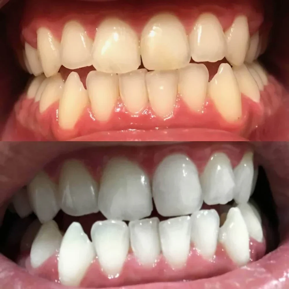 Teeth Whitening Pen - Radiant smile in 10 minutes - Image 4