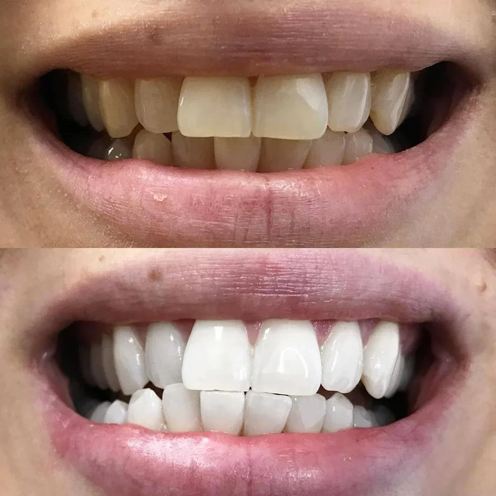 Teeth Whitening Pen - Radiant smile in 10 minutes - Image 6