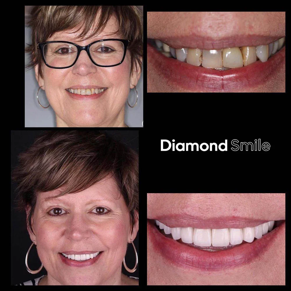 Premium Teeth Whitening Set + Serum + Teeth Whitening Strips - Image 14