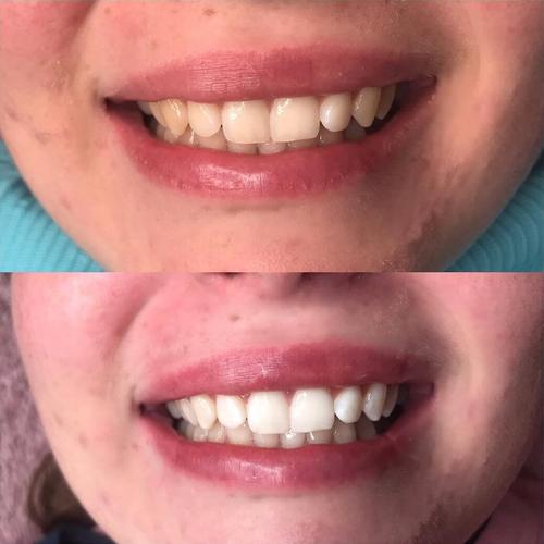 Premium Teeth Whitening Set + Serum + Teeth Whitening Strips - Image 6