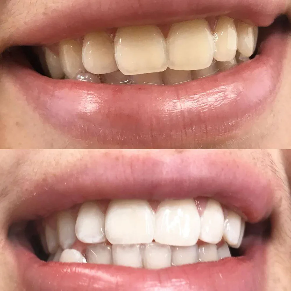 Premium Teeth Whitening Set + Serum + Teeth Whitening Strips - Image 7