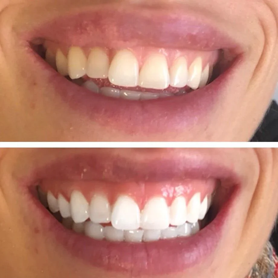 Teeth Whitening White Strips - Image 8