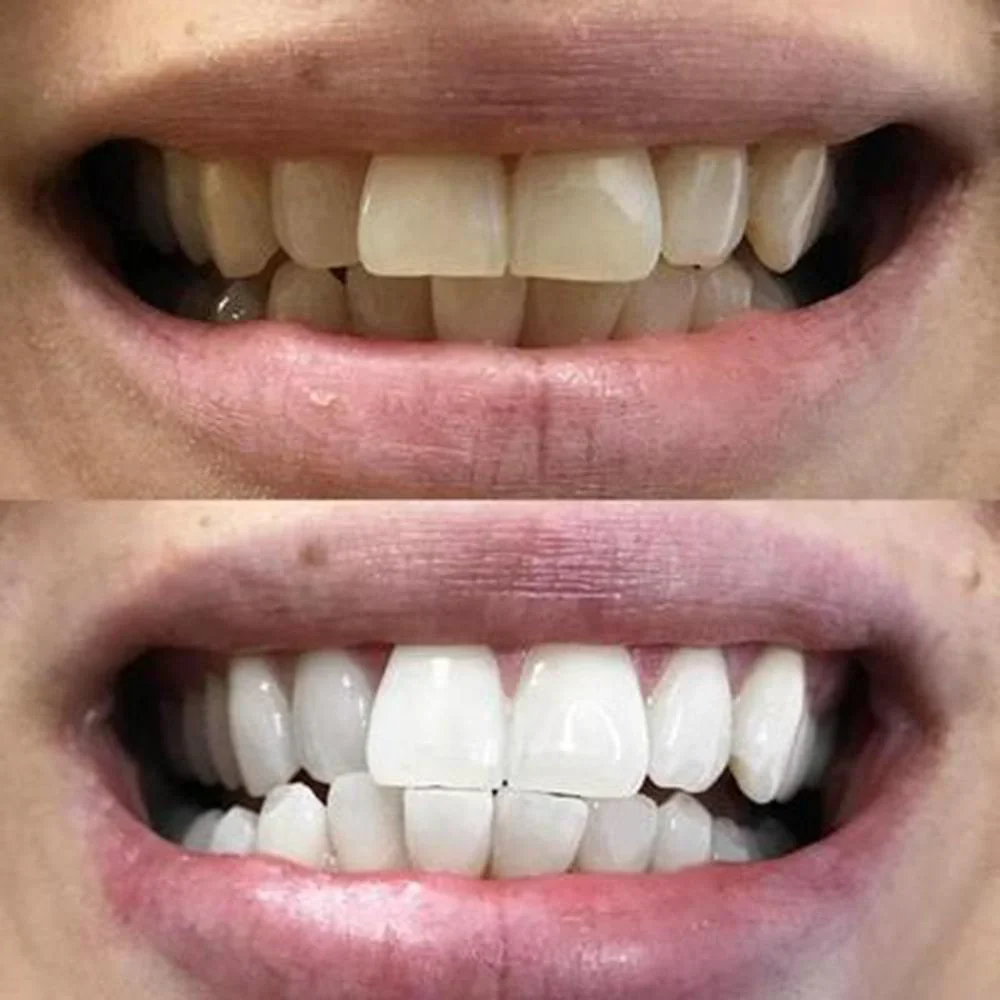 Teeth Whitening White Strips - Image 9